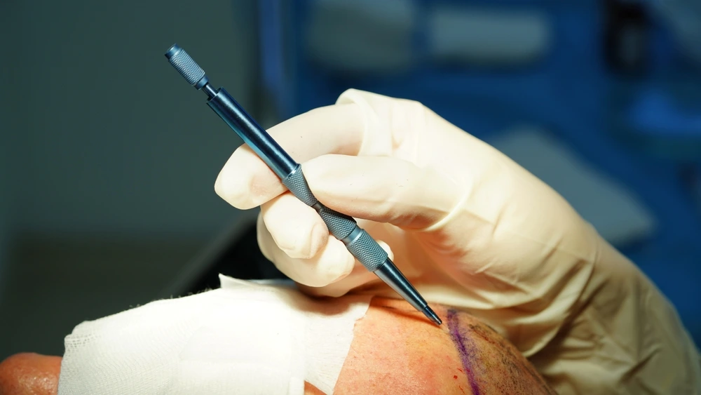 The Evolution of Follicular Restoration with sapphire hair transplant