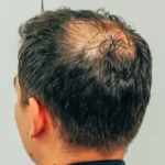 crown hair transplant