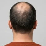 Telogen Effluvium or Male Pattern  Baldness How to Tell the Difference Before