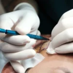 sapphire fue hair transplant