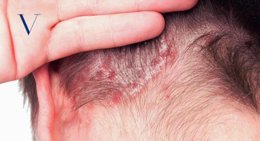 7 Signs That Reveal Whether It's Scalp Psoriasis or Dandruff