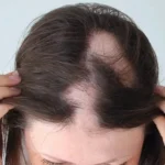 Hair Grow Back After Scarring Alopecia