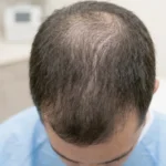 Can You Have Both Telogen Effluvium and Androgenetic Alopecia at the Same Time