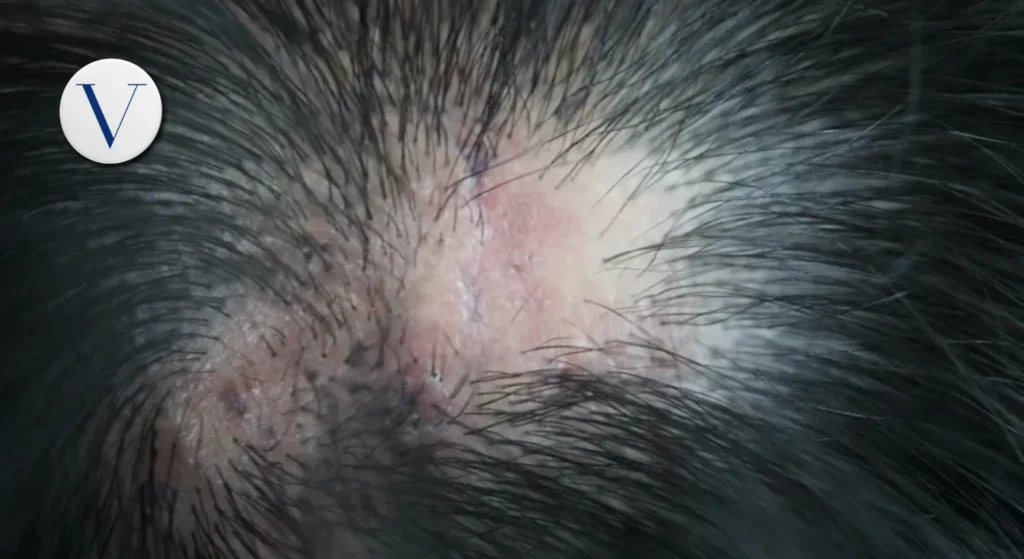 Is Lichen Planopilaris Permanent Causes, Scalp Pain & Hair Loss