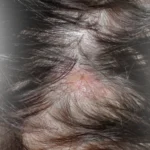 Is Lichen Planopilaris Permanent Causes, Scalp Pain & Hair Loss