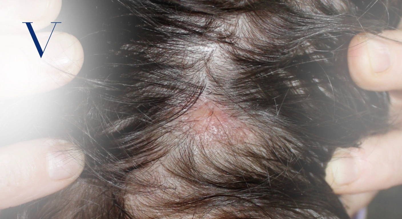 Is Lichen Planopilaris Permanent Causes, Scalp Pain & Hair Loss