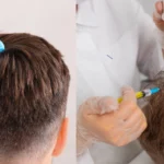 Does PRP or Exosome Therapy Work Better for Early Hair Loss?