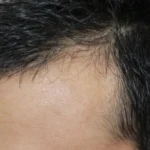 Scalp Hair Transplant vs Regular Hair Transplant