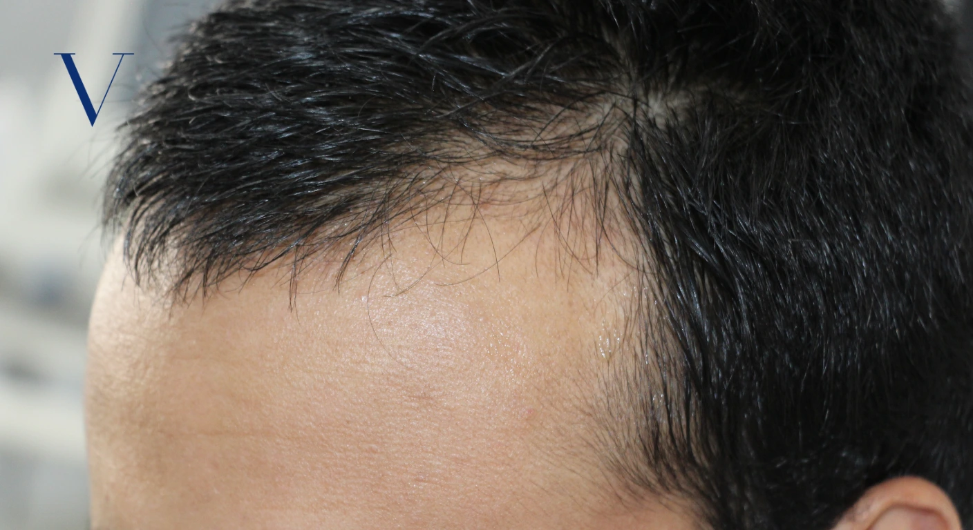 Scalp Hair Transplant vs Regular Hair Transplant