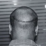 What Are the Side Effects of FUT Hair Transplant Procedures