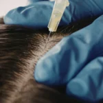 Does PRP therapy work on receding hairlines or only crown thinning
