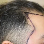 natural frontal hairline fue