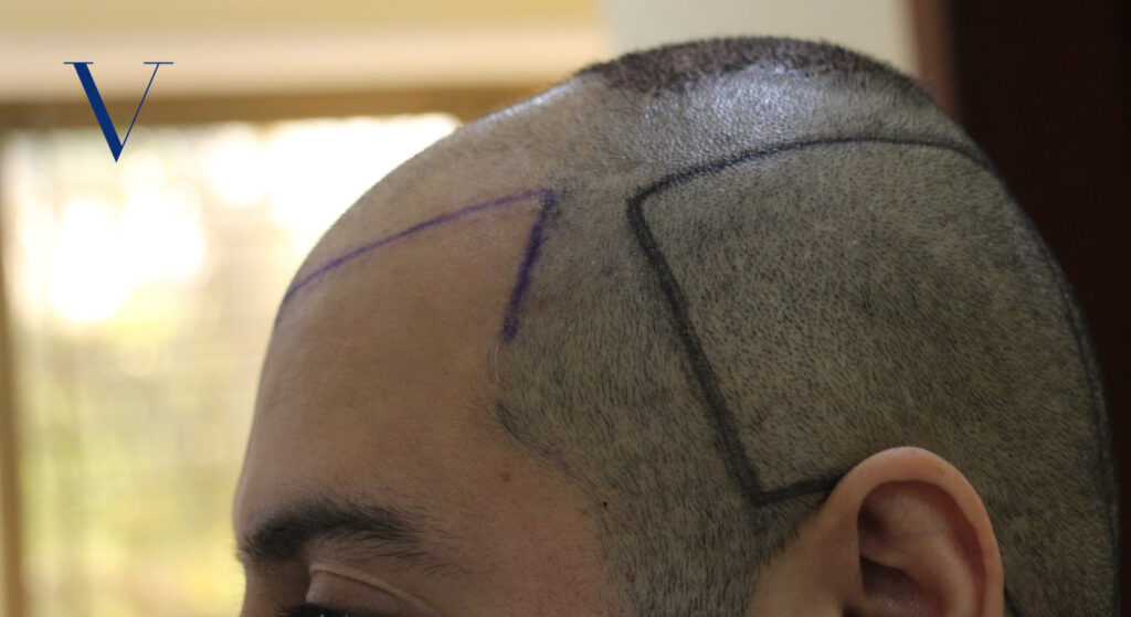 natural frontal hairline fue